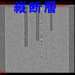 X線CTのリングアーチファクト 縦断層